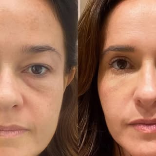 21 dias de pós operatório de blefaroplastia superior e inferior , lipoenxertia e radiofrequência mic