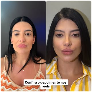 #cirurgiaplástica #liftingfacial