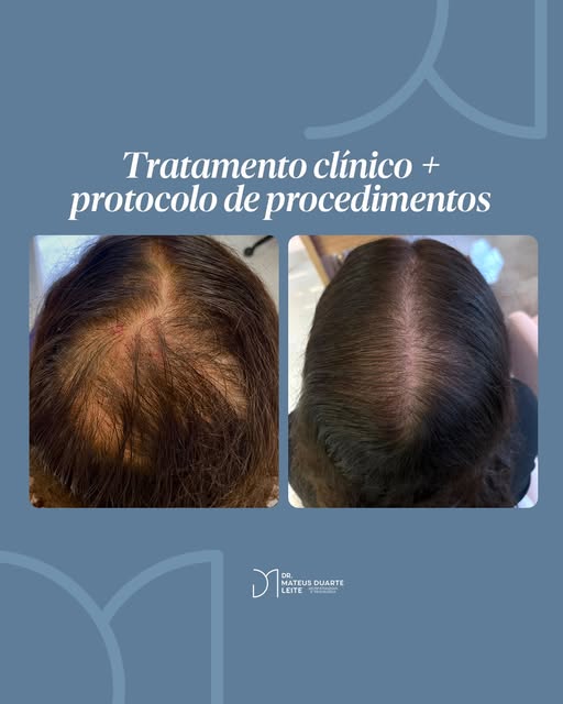 Neste caso, o diagnóstico foi de alopecia androgenética masculina e a condução envolveu tratamento c