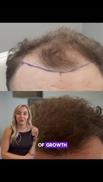✨ Considering a hair transplant?

Check out our latest case by the amazing Dr M 🧑‍⚕️

We know how t