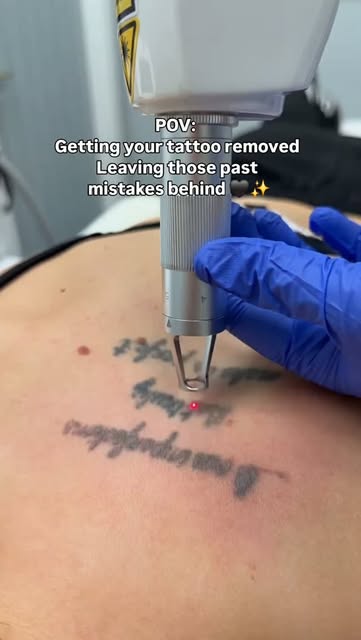 POV: Getting your tattoo removed and leaving those past mistakes behind 🖤✨

📣 DM us 
🌐 pmclinic.c