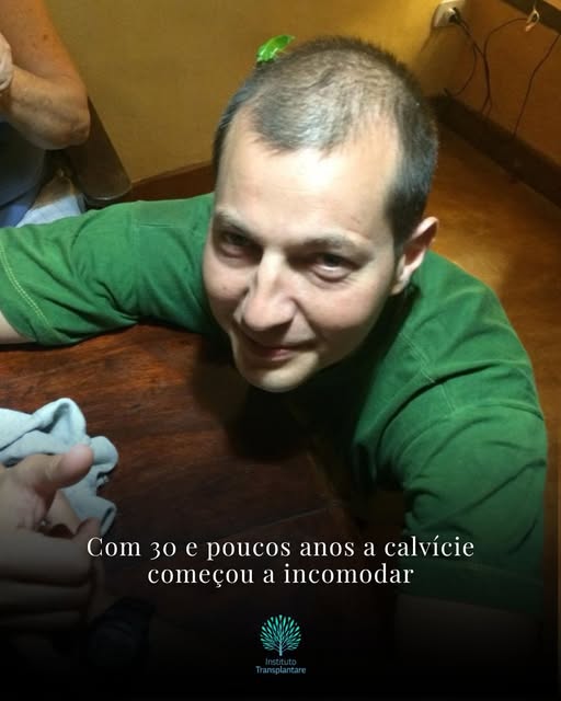 A face deve ser analisada por completa. 

Muitas vezes realizar somente um transplante capilar será 
