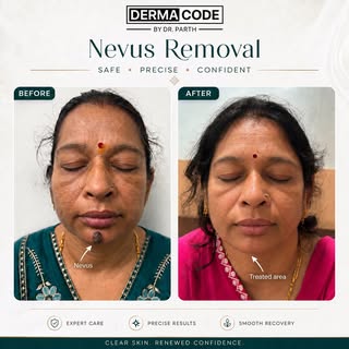 Transform Your Skin with Safe & Precise Nevus Removal at Dermacode

Say goodbye to unwanted facial m