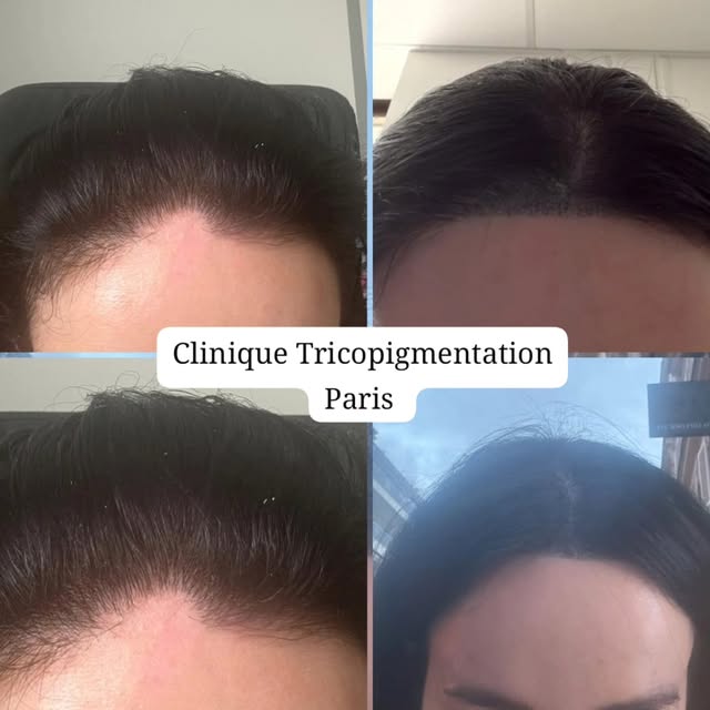 Correction de la ligne frontale  féminine suite à  une perte de cheveux stress 🫡 #tricopigmentation