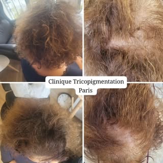 Densification capillaire féminine suite à  une perte de cheveux alopécie androgénétique 🫡 #tricopig