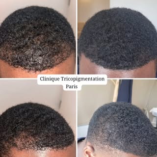 Densification capillaire masculine suite à  une perte de cheveux  alopecie androgénétique 🫡 #tricop