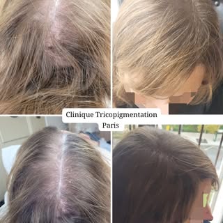 Densification capillaire féminine suite à  une perte de cheveux alopécie androgénétique 🫡 #tricopig