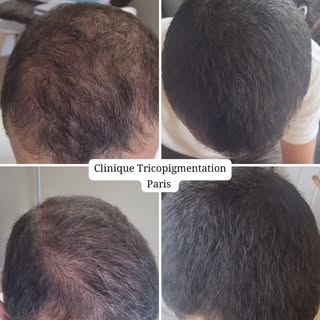 Densification capillaire masculine suite à  une perte de cheveux  alopecie androgénétique 🫡 #tricop