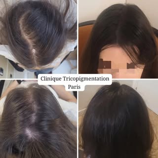Densification capillaire féminine suite à  une perte de cheveux alopécie androgénétique 🫡 #tricopig