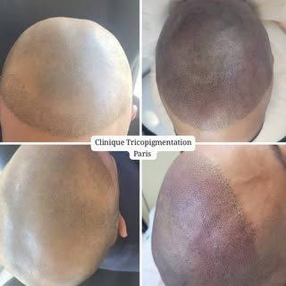 Seance 1: Correction  greffe de cheveux ratée Séance 1 avant correction de la ligne frontale 🫡 #tri