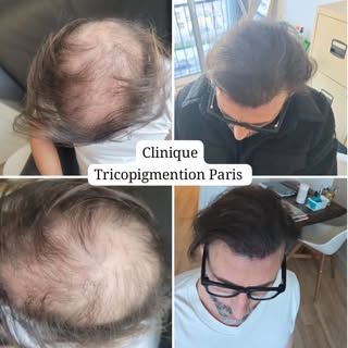 Densification capillaire masculine suite à  une perte de cheveux  alopecie androgénétique 🫡 #tricop