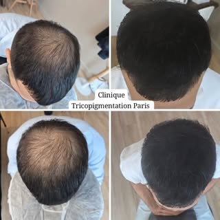 Densification capillaire masculine suite à  une perte de cheveux  alopecie androgénétique 🫡 #tricop