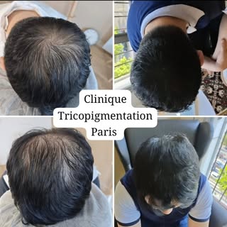 Densification capillaire masculine suite à  une perte de cheveux  alopecie androgénétique 🫡 #tricop