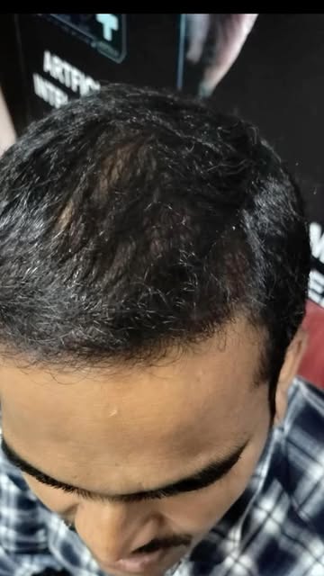 Transforming confidence, one follicle at a time! ✨ Witness the incredible journey of hair restoratio