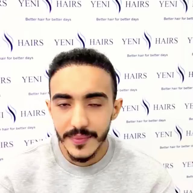 هل ترددتم من قبل في تصديق صور نتائجنا؟ عند نشر صور السيد يوسف قبل وبعد عملية زراعة الشعر، أضفنا ضباب