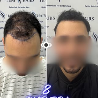 قبل العملية، كان تساقط الشعر واضحا في بعض المناطق، ومعه بدأ الإحساس بعدم الرضا عن المظهر يظهر تدريجي