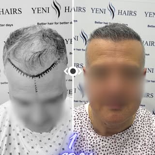 😟 هل بدأت تلاحظ أن الفراغات في مقدمة رأسك أصبحت أوضح؟

كثيرون يمرّون بنفس المرحلة… يبدأ خط الشعر با