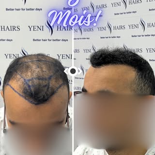 ليس السؤال: “هل زراعة الشعر تنجح؟”
السؤال الحقيقي: كم ستنتظر قبل أن ترى هذه النتيجة على رأسك؟

في 6 