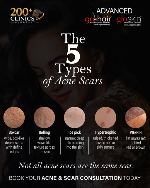 Not all acne scars are the same, and neither is the right treatment! 

From deep ice-pick scars to r