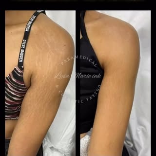 Say goodbye to stretch marks with Inkless Stretch Mark Revision! ✨
This innovative treatment helps f