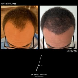 5 meses pós transplante capilar sob terapêutica farmacológica. 

~ 30% do resultado final

Resultado