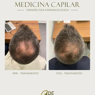 Os tratamentos de medicina estética capilar são sempre precedidos de uma avaliação detalhada e um di