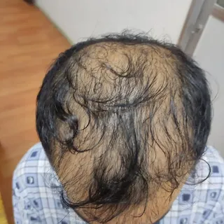 Success story@radiant skin clinics

Hair transplant repair after first unsuccessful hair transplant 