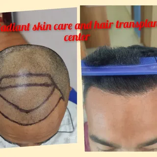 Premium hair transplant service in Nepal @ Radiant skin care and hair transplant center 

#hairtrans