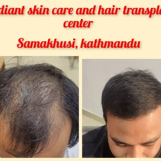 Hair transplant in Nepal

Contact us for best hair transplant experience in Nepal

#skincaredoctorin