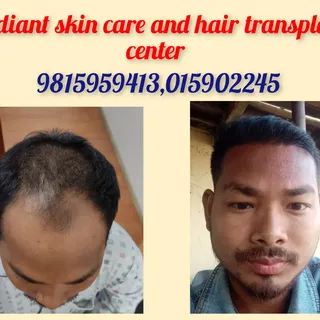 Hair transplant in Nepal

Contact us for best hair transplant experience in Nepal

#skincaredoctorin