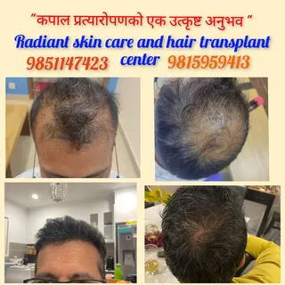 Hair transplant in Nepal

6 months results
3500 grafts used

Contact us for best hair transplant exp