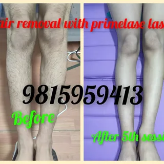 We use Primelase Laser for hair removal. Triple wavelength laser US FDA Approved machine Made in Spa