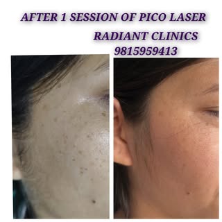 After single session of PICO LASER 
freckles removal by pico laser 
#frecklestreatment
#melasmatreat