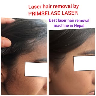Laser Hair Removal in Nepal
most advanced system in nepal for hair removal
Get rid of unwanted hair 