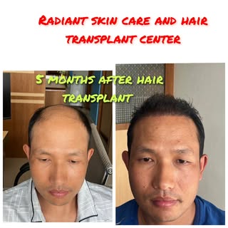 Premium hair transplant service in Nepal @ Radiant skin care and hair transplant center 

#hairtrans