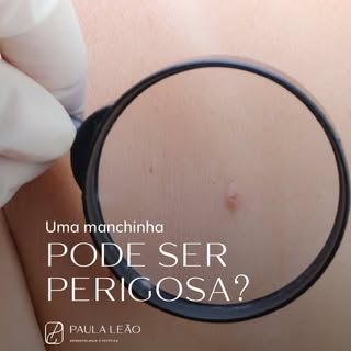 Antes de pensar se uma mancha é “bonita” ou “feia”, vale lembrar: estética não é diagnóstico. 

👉🏻