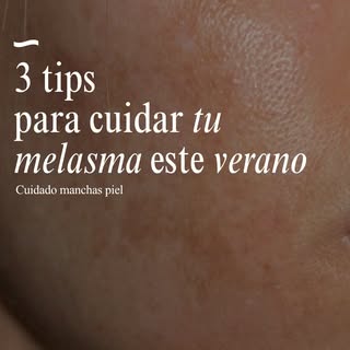 ¿Tienes melasma y no sabes cómo evitar que empeore en verano? ☀️

El sol es uno de los principales d