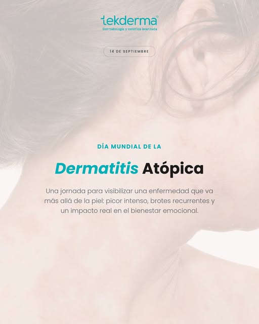 Hoy, 14 de septiembre, es el Día Mundial de la Dermatitis Atópica, una enfermedad inflamatoria cróni