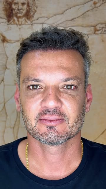 12 meses de resultado pós transplante capilar. @drdanielreiss