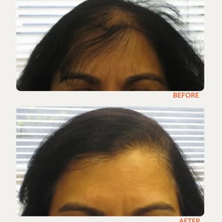 When creating a hairline design, our goal is to achieve a natural-looking and flattering aesthetic t