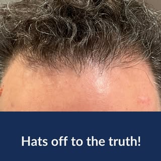 𝗛𝗮𝘁𝘀 𝗼𝗳𝗳 𝘁𝗼 𝘁𝗵𝗲 𝘁𝗿𝘂𝘁𝗵 🧢
Wearing a hat doesn’t cause hair loss — people wear hats b