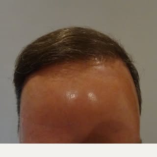 The central paradox in hair transplantation is this: the more extensive your hair loss, the less don