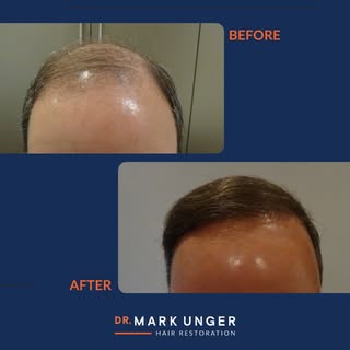 Adding to my previous post, here is a series of before and after photos from one of our patients. Th
