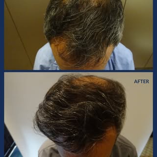 This patient returned one year after their initial frontal transplant. A second transplant is planne