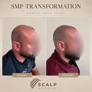 Weniger kahle Stellen. Mehr Fülle.

Bei dieser SMP Verdichtung wurde die bestehende Haarstruktur gez