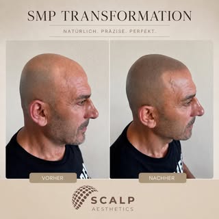 Mehr Definition. Mehr Ausdruck. Mehr Selbstbewusstsein.
SMP mit natürlichem Ergebnis. ✨
#scalpmicrop
