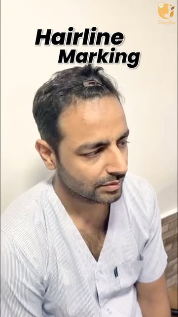 Hairline Design
A natural hairline starts with the right planning. ✨

Precision, balance & a persona
