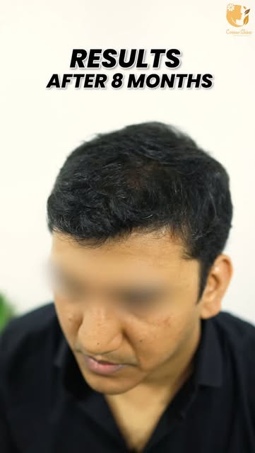 From hair loss to a fuller, more confident look! ✨
Here’s a glimpse of the Hair Transplant result af