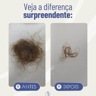 Quando o emocional adoece, o corpo sente, e o cabelo responde.

Neste caso de eflúvio telógeno bem s