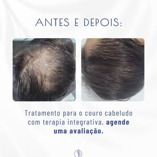 Terapia capilar associada a práticas integrativas, solução que pode evitar transplante.

Quando os f